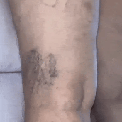 VENA RELIEF™ CREMA PARA VÁRICES – PIERNAS MÁS LIGERAS Y CUIDADAS | ENVÍO GRATIS 🦵✨